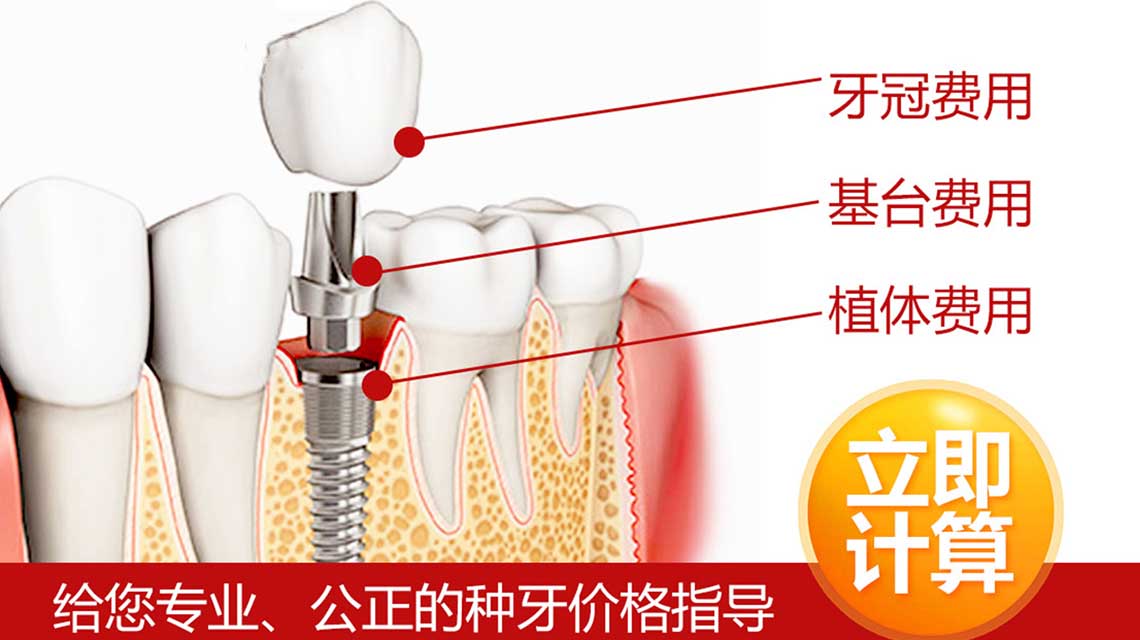 种植牙价格,种植牙多少钱,种植牙费用