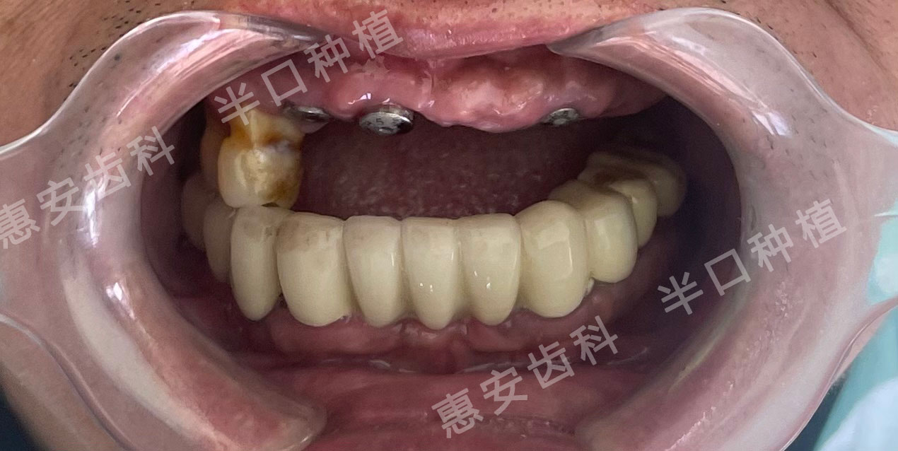 全口种植牙,半口种植牙,全口假牙修复,半口假牙修复